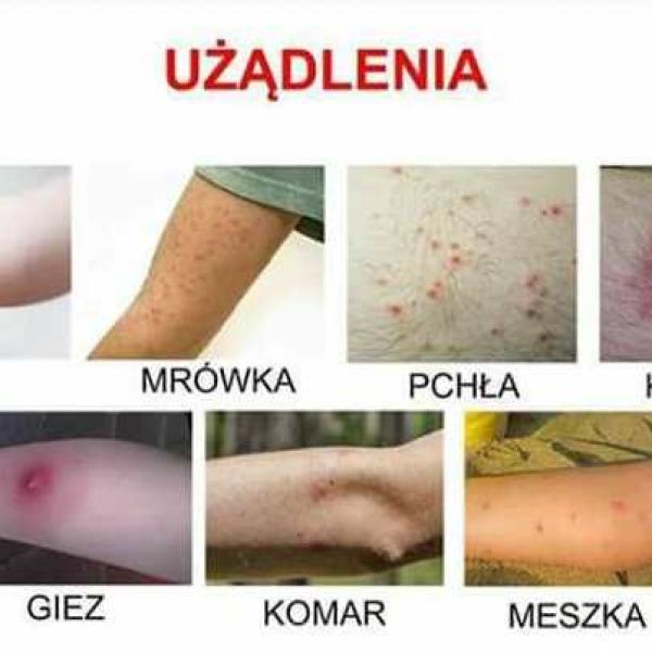 Wskazówki, jak postępować w przypadku użądleń